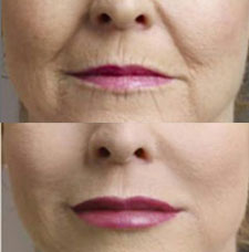 non surgical wrinkle removal image25
