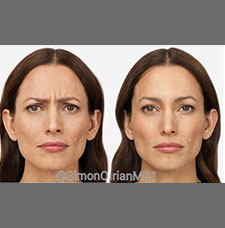 non surgical wrinkle removal image26