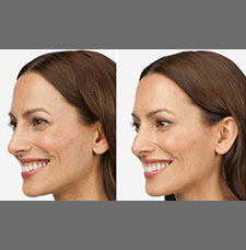 non surgical wrinkle removal image27