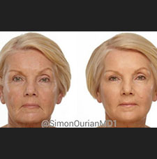 non surgical wrinkle removal image28
