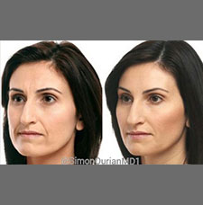 non surgical wrinkle removal image29