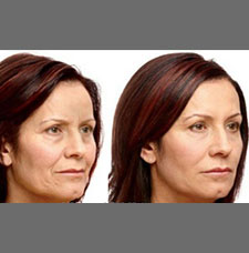 non surgical wrinkle removal image31
