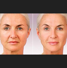 non surgical wrinkle removal image32
