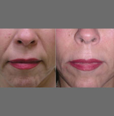 non surgical wrinkle removal image5