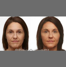 non surgical wrinkle removal image6