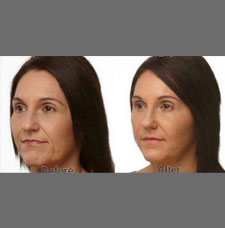 non surgical wrinkle removal image7