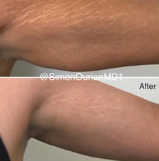 skin resurfacing image1