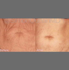 skin resurfacing image3