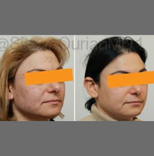 skin resurfacing image3