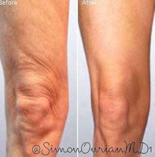 skin resurfacing image4