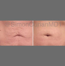 skin resurfacing image5