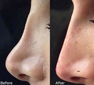 nose surgery 2