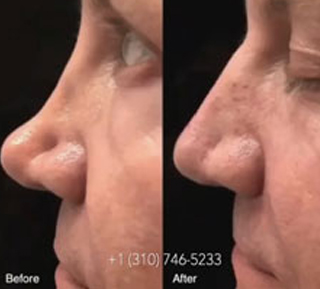 nose surgery 3