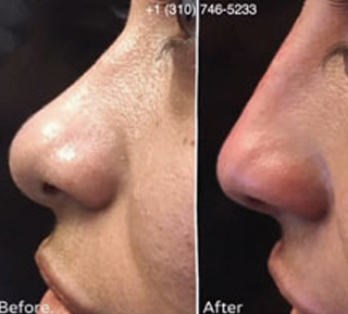 nose surgery 4