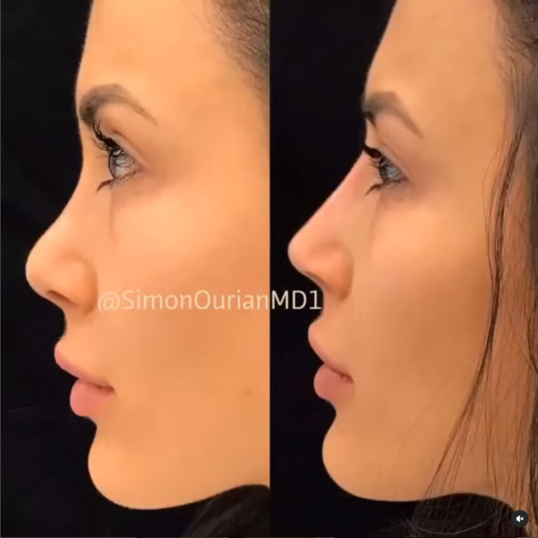 Non Surgical Nose job Before and After Photo Gallery Epione