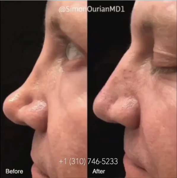Non Surgical Nose Job image14