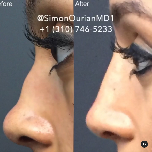 Non Surgical Nose Job image22