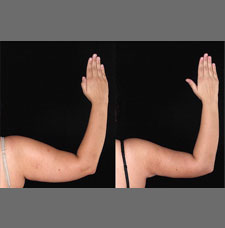 non surgical arm lift image3