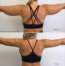 non surgical arm lift image1