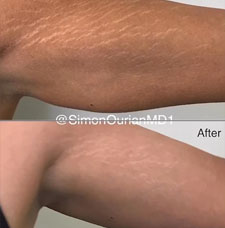 non surgical arm lift image4