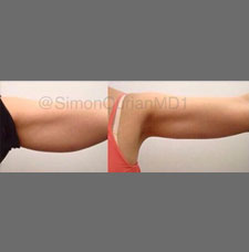 non surgical arm lift image2