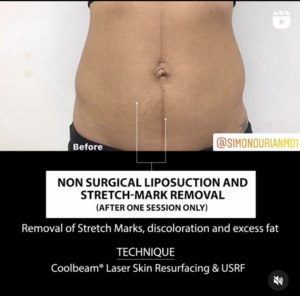 concept image of patient before non-surgical liposuction