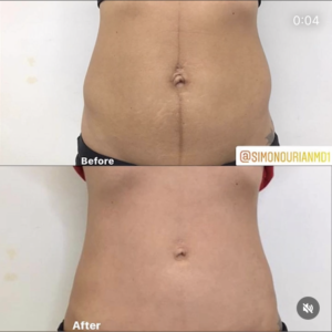 before and after liposuction patient