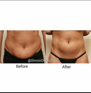before and after liposuction patient