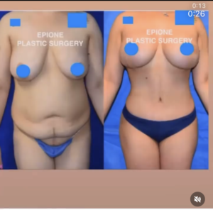 patient before and after breast liposuction (non-surgical)
