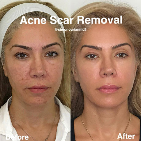 Understanding Acne Scars before & after picture
