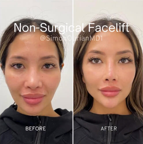 Non-Surgical Facelift before & after picture 