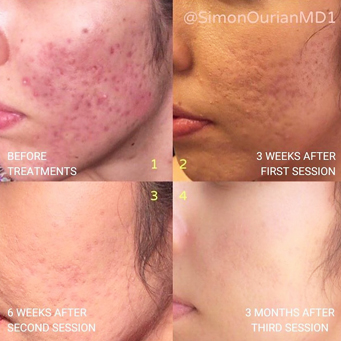 before after image of coolfrax treatment