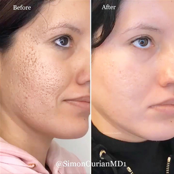 before and after image of coolfrax treatment