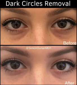 real patient before and after dark circle treatment