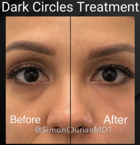 dark circles before and after