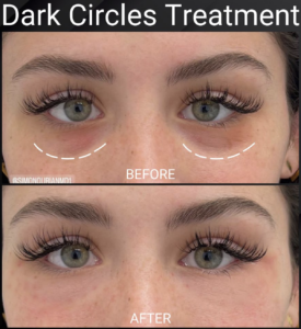 dark circles treatment before and after
