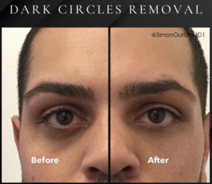 male patient before and after dark circles removal treatment
