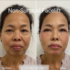 before and after facelift results for Epione patient