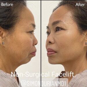 before and after non-surgical facelift results