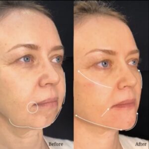 sample image for facial contouring patient
