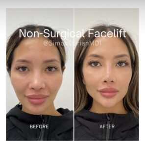 non-surgical facelift before and after results