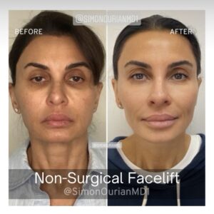 before and after facelift with jawline contouring