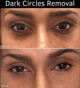 before and after results for under-eye dark circle treatment at Epione