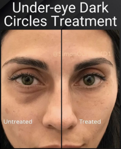 results of dark circles treatment patient