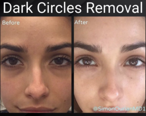young woman before and after having dark circles removed (from Instagram)