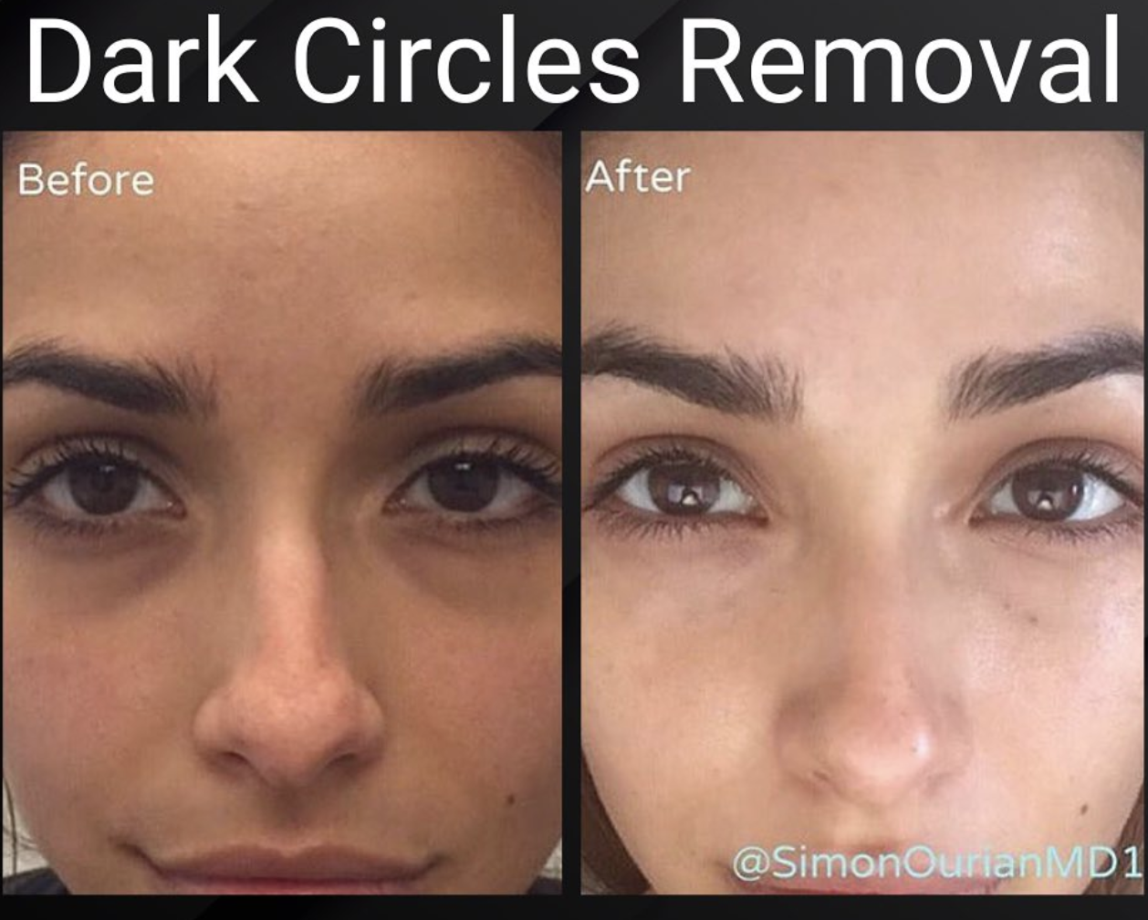 Rejuvenate Your Eyes with Under Eye Dark Circles Filler Does It Really