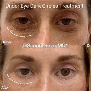 before and after image of under-eye dark circle removal