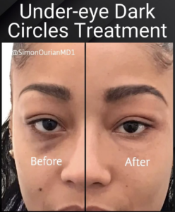 patient before and after dark circles treatment