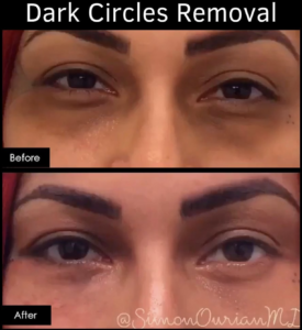 before and after under-eye injections patient results