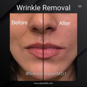 before and after wrinkle removal patient